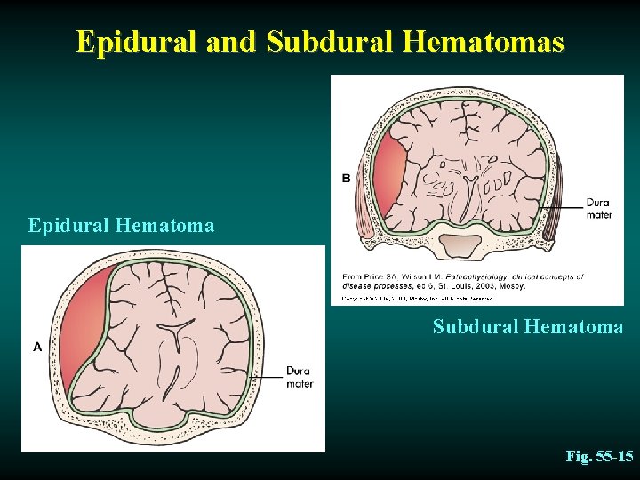 Epidural and Subdural Hematomas Epidural Hematoma Subdural Hematoma Fig. 55 -15 