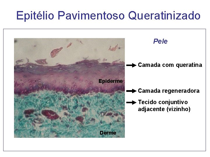 Epitélio Pavimentoso Queratinizado Pele Camada com queratina Epiderme Camada regeneradora Tecido conjuntivo adjacente (vizinho) Epitélio Pavimentoso Queratinizado Pele Camada com queratina Epiderme Camada regeneradora Tecido conjuntivo adjacente (vizinho)