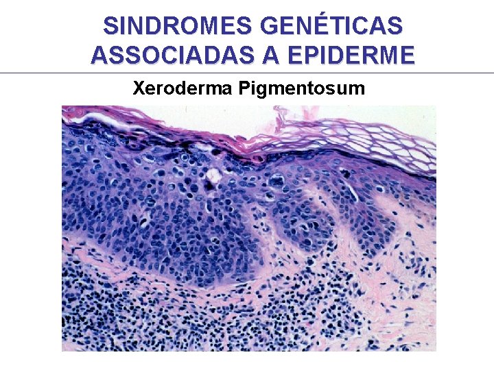 SINDROMES GENÉTICAS ASSOCIADAS A EPIDERME Xeroderma Pigmentosum SINDROMES GENÉTICAS ASSOCIADAS A EPIDERME Xeroderma Pigmentosum