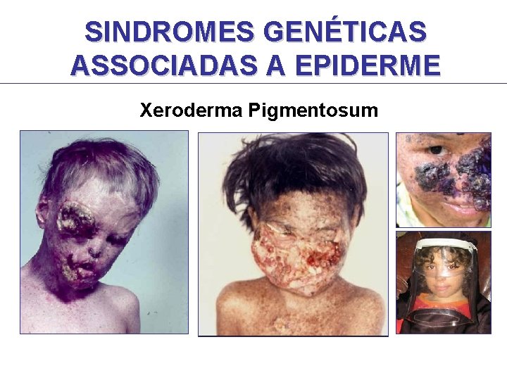 SINDROMES GENÉTICAS ASSOCIADAS A EPIDERME Xeroderma Pigmentosum SINDROMES GENÉTICAS ASSOCIADAS A EPIDERME Xeroderma Pigmentosum