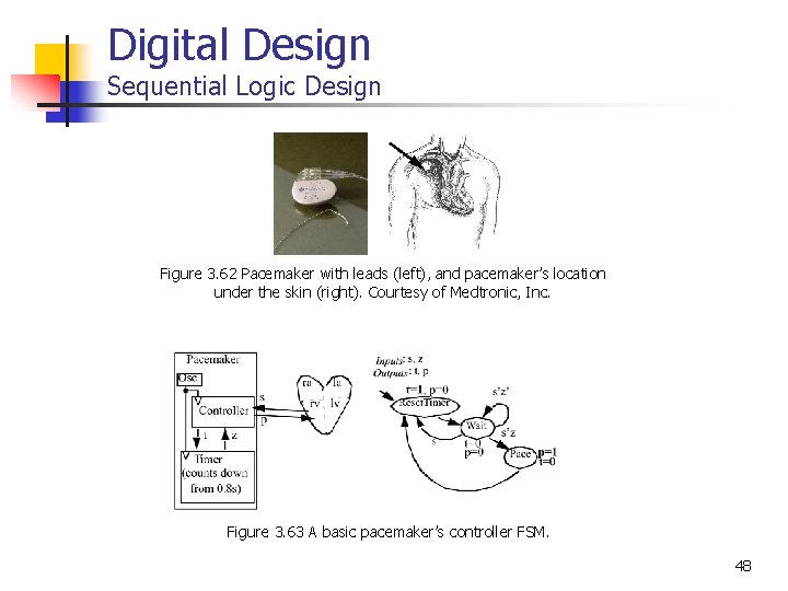 Digital Design Sequential Logic Design Figure 3. 62 Pacemaker with leads (left), and pacemaker’s