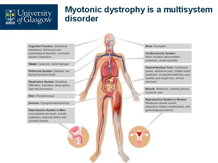 Myotonic dystrophy is a multisystem disorder 