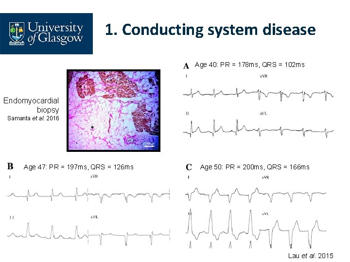 1. Conducting system disease Age 40: PR = 178 ms, QRS = 102 ms