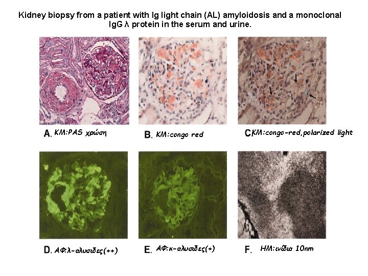 Kidney biopsy from a patient with Ig light chain (AL) amyloidosis and a monoclonal