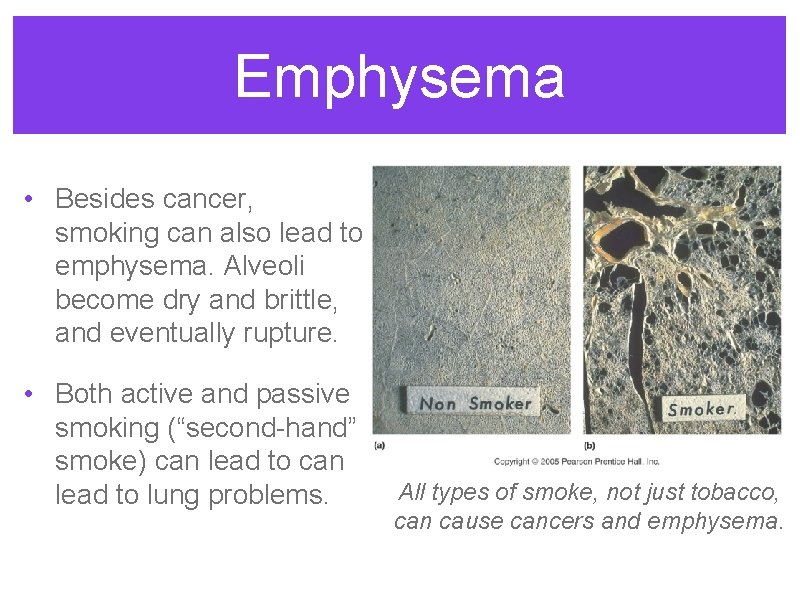 Emphysema • Besides cancer, smoking can also lead to emphysema. Alveoli become dry and