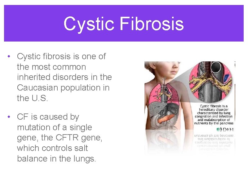 Cystic Fibrosis • Cystic fibrosis is one of the most common inherited disorders in