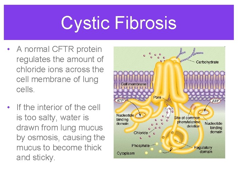 Cystic Fibrosis • A normal CFTR protein regulates the amount of chloride ions across