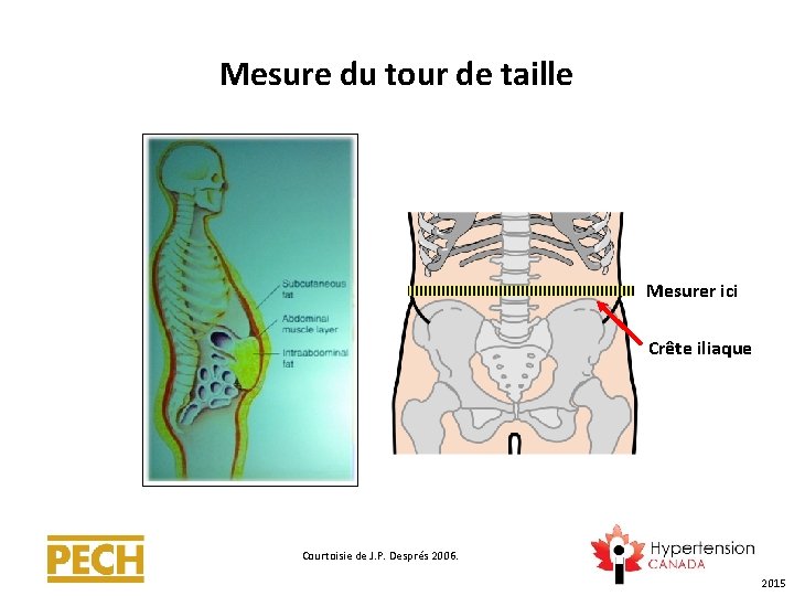 Mesure du tour de taille Mesurer ici Crête iliaque Courtoisie de J. P. Després