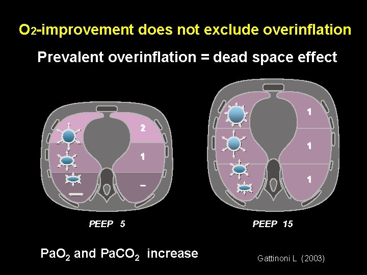 O 2 -improvement does not exclude overinflation Prevalent overinflation = dead space effect 1