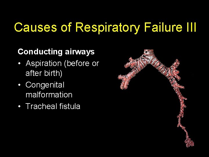 Causes of Respiratory Failure III Conducting airways • Aspiration (before or after birth) •