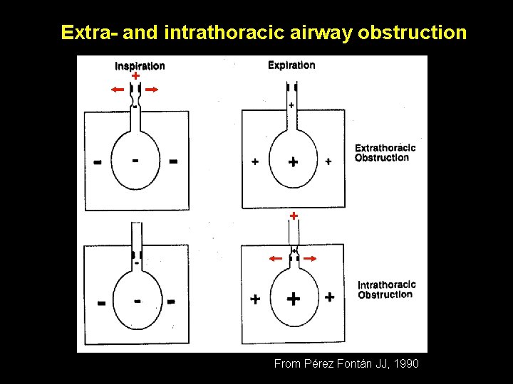 Extra- and intrathoracic airway obstruction + Stridor + From Pérez Fontán JJ, 1990 