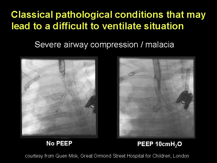 Classical pathological conditions that may lead to a difficult to ventilate situation Severe airway