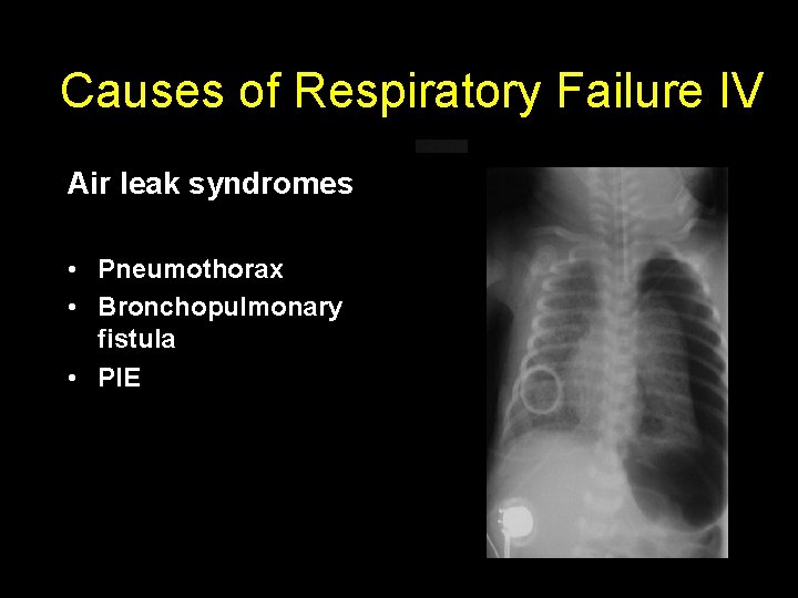 Causes of Respiratory Failure IV Air leak syndromes • Pneumothorax • Bronchopulmonary fistula •