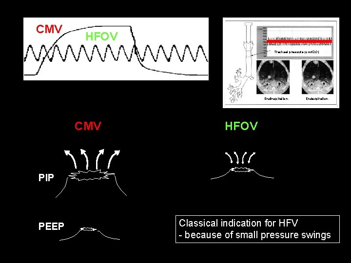 CMV HFOV Tracheal pressure (cm. H 2 O) Endinspiration CMV Endexpiration HFOV PIP PEEP