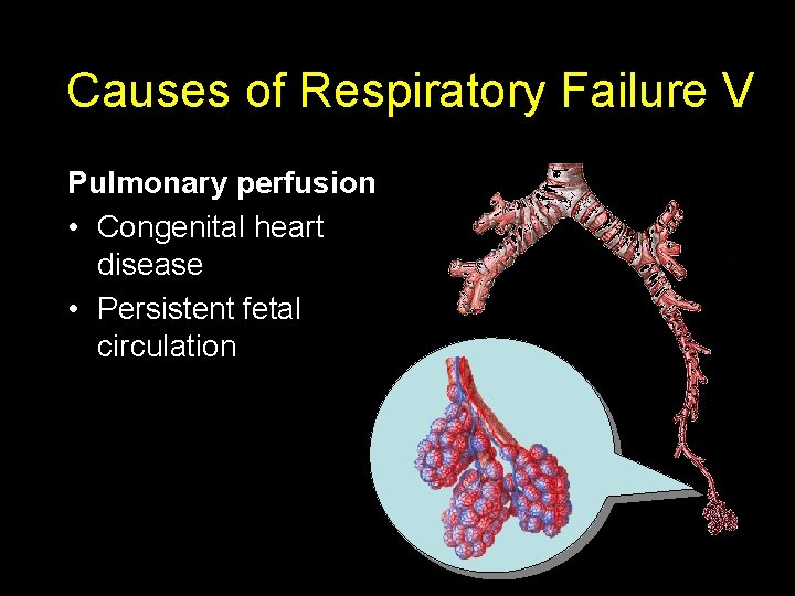 Causes of Respiratory Failure V Pulmonary perfusion • Congenital heart disease • Persistent fetal