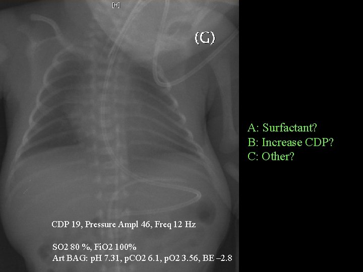 A: Surfactant? B: Increase CDP? C: Other? CDP 19, Pressure Ampl 46, Freq 12