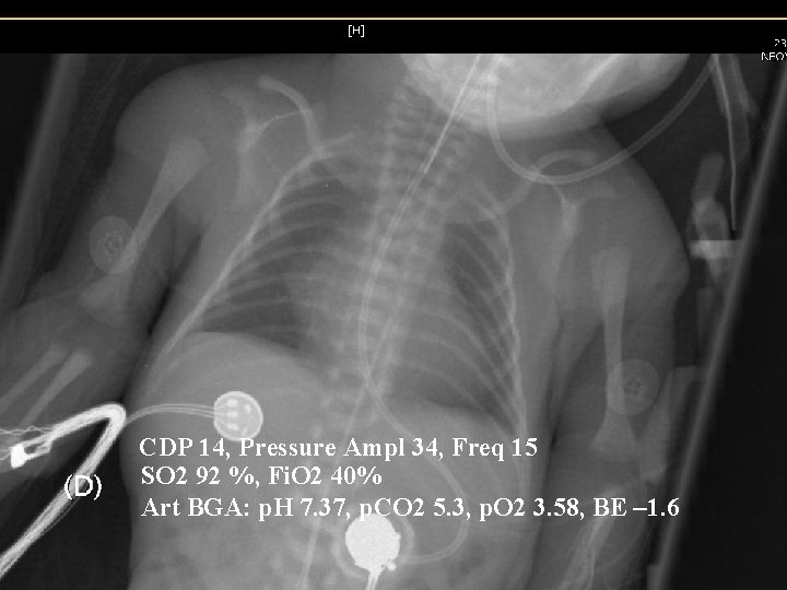 CDP 14, Pressure Ampl 34, Freq 15 SO 2 92 %, Fi. O 2