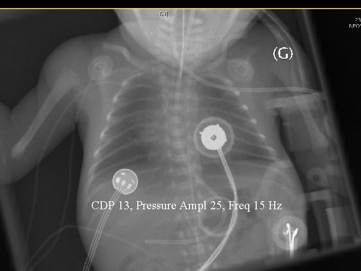 CDP 13, Pressure Ampl 25, Freq 15 Hz 
