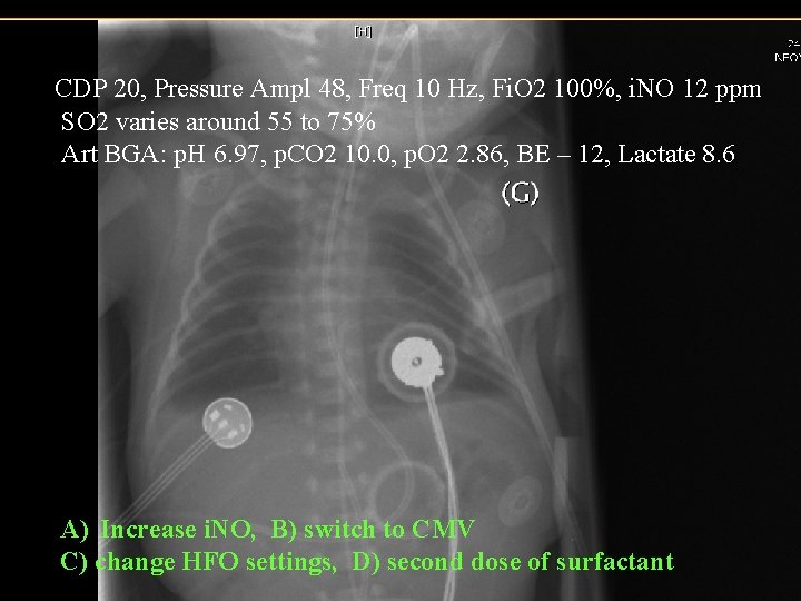 CDP 20, Pressure Ampl 48, Freq 10 Hz, Fi. O 2 100%, i. NO