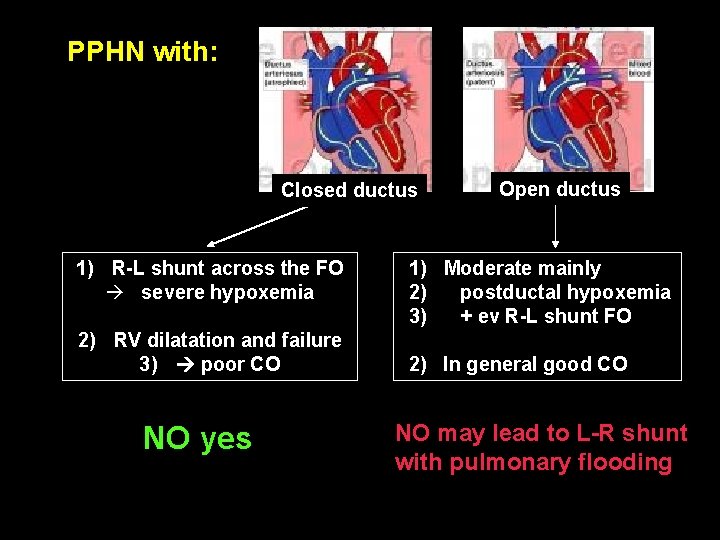PPHN with: Closed ductus 1) R-L shunt across the FO severe hypoxemia 2) RV
