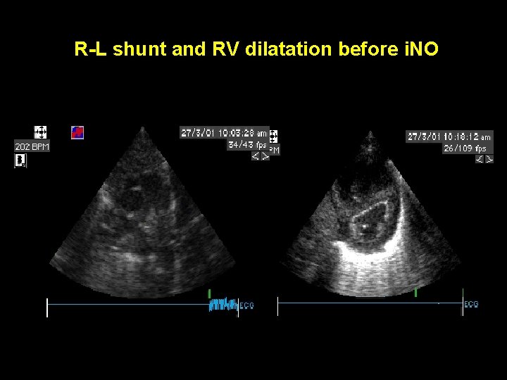 R-L shunt and RV dilatation before i. NO 