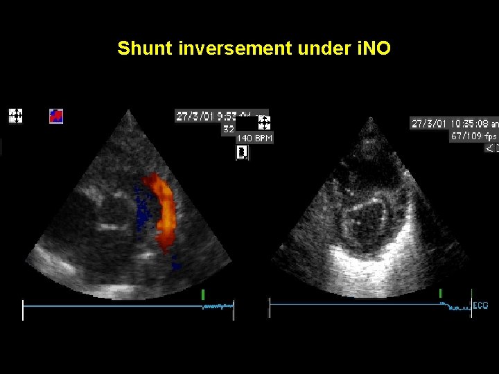 Shunt inversement under i. NO 