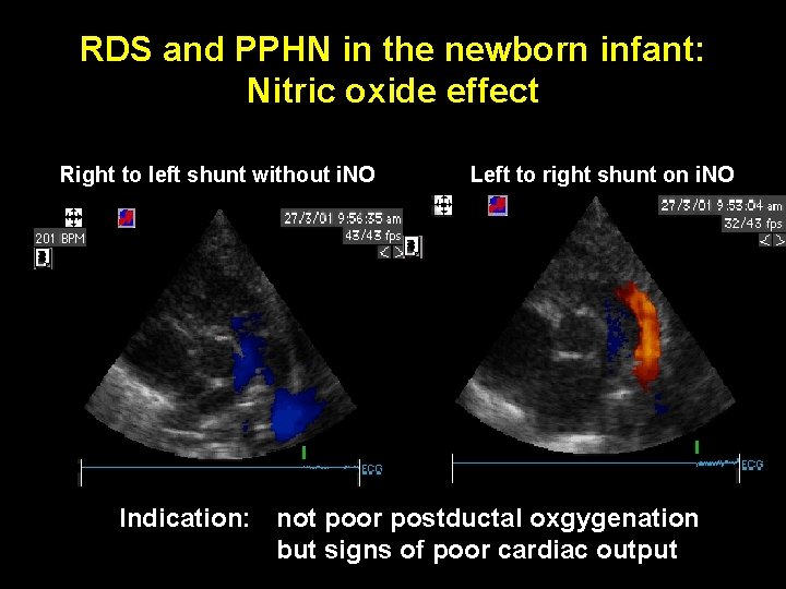 RDS and PPHN in the newborn infant: Nitric oxide effect Right to left shunt