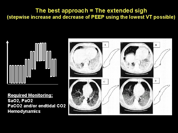 The best approach = The extended sigh (stepwise increase and decrease of PEEP using