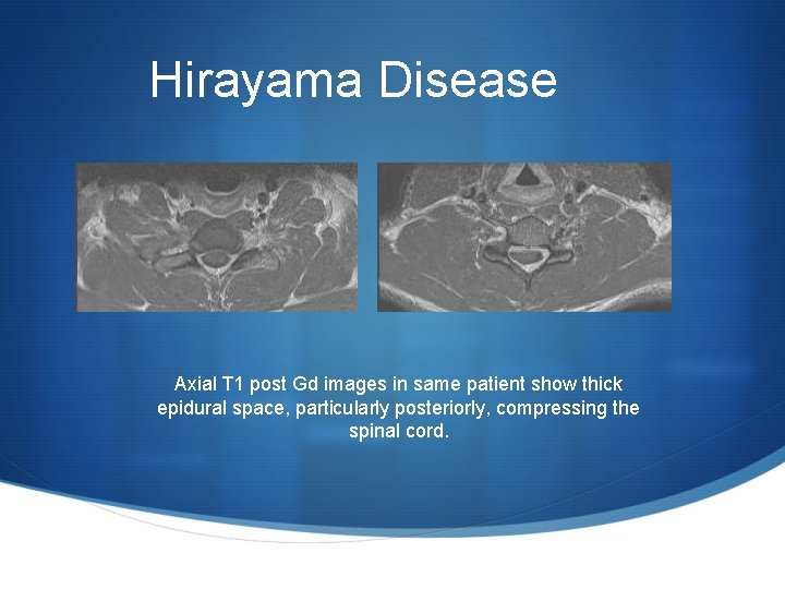 Hirayama Disease Axial T 1 post Gd images in same patient show thick epidural