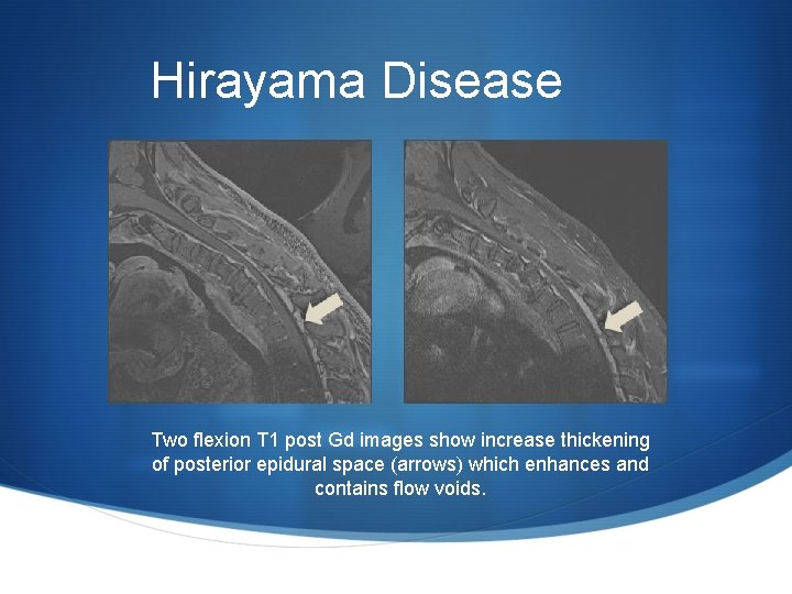 Hirayama Disease Two flexion T 1 post Gd images show increase thickening of posterior