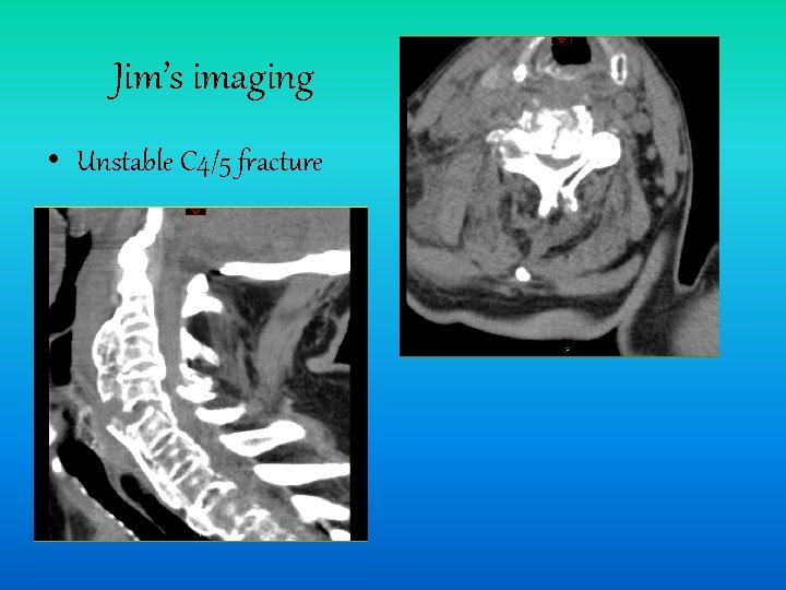 Jim’s imaging • Unstable C 4/5 fracture 