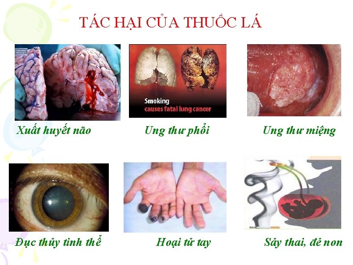 TÁC HẠI CỦA THUỐC LÁ Xuất huyết não Đục thủy tinh thể Ung thư