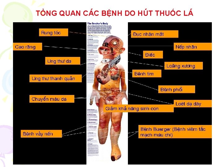 TỔNG QUAN CÁC BỆNH DO HÚT THUỐC LÁ 