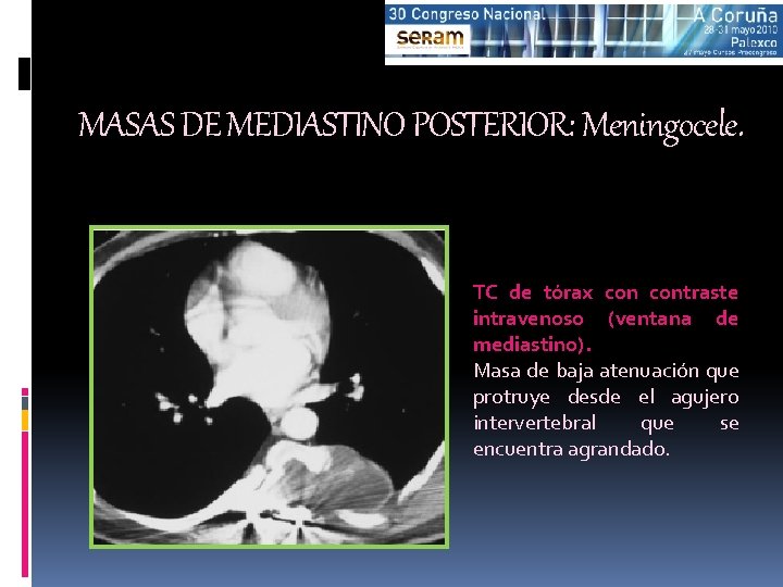 MASAS DE MEDIASTINO POSTERIOR: Meningocele. TC de tórax contraste intravenoso (ventana de mediastino). Masa