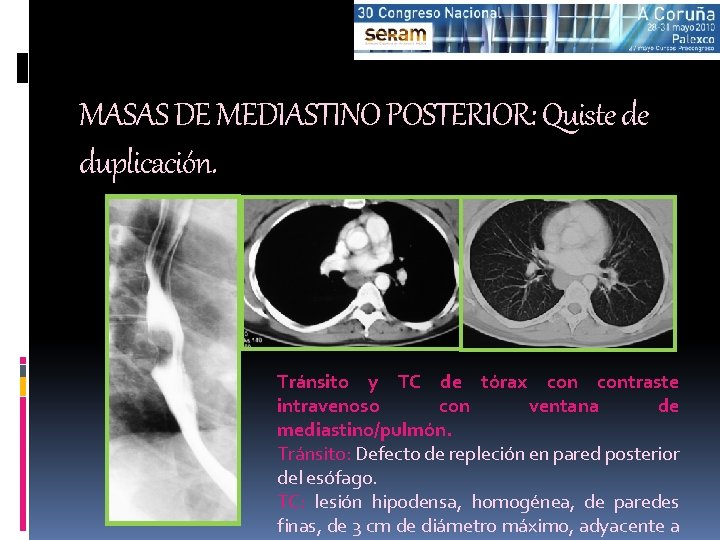 MASAS DE MEDIASTINO POSTERIOR: Quiste de duplicación. Tránsito y TC de tórax contraste intravenoso