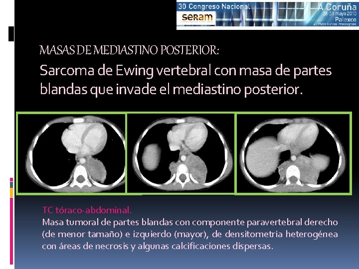 MASAS DE MEDIASTINO POSTERIOR: Sarcoma de Ewing vertebral con masa de partes blandas que
