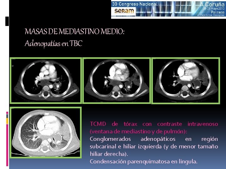 MASAS DE MEDIASTINO MEDIO: Adenopatías en TBC TCMD de tórax contraste intravenoso (ventana de