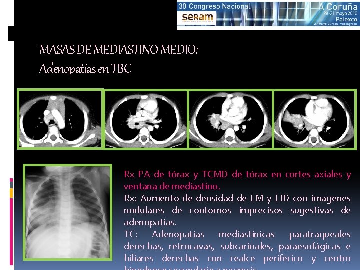 MASAS DE MEDIASTINO MEDIO: Adenopatías en TBC Rx PA de tórax y TCMD de
