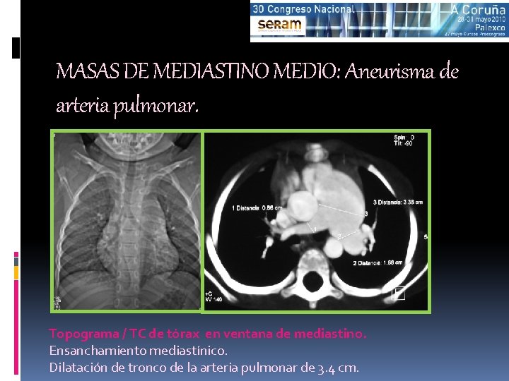 MASAS DE MEDIASTINO MEDIO: Aneurisma de arteria pulmonar. Topograma / TC de tórax en