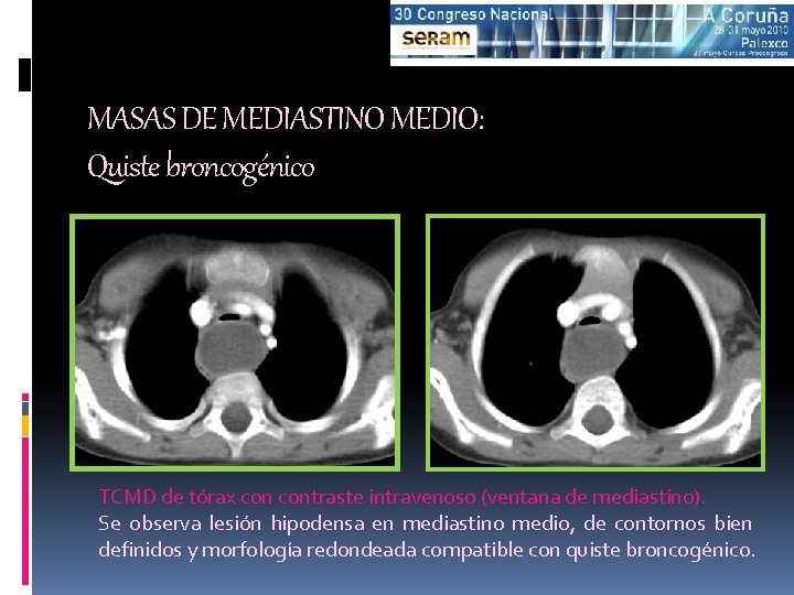 MASAS DE MEDIASTINO MEDIO: Quiste broncogénico TCMD de tórax contraste intravenoso (ventana de mediastino).