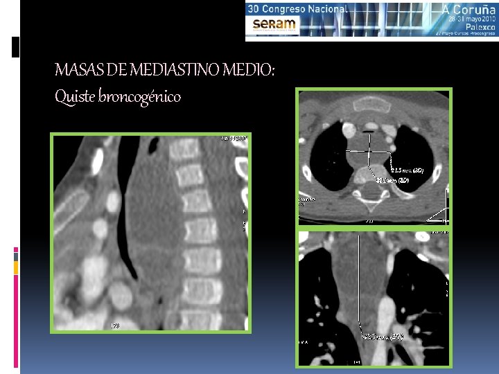 MASAS DE MEDIASTINO MEDIO: Quiste broncogénico 
