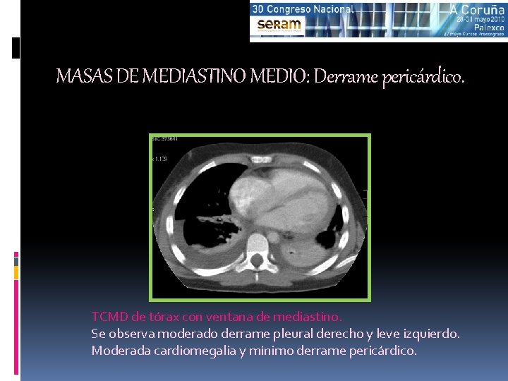 MASAS DE MEDIASTINO MEDIO: Derrame pericárdico. TCMD de tórax con ventana de mediastino. Se