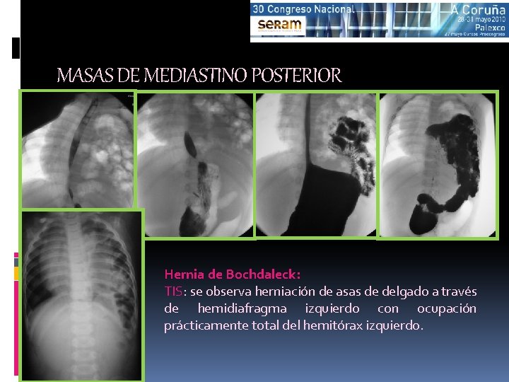 MASAS DE MEDIASTINO POSTERIOR Hernia de Bochdaleck: TIS: se observa herniación de asas de