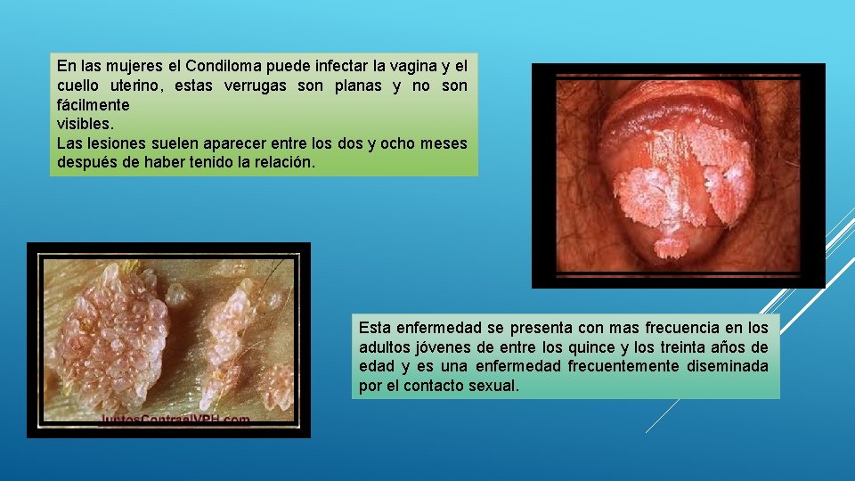 En las mujeres el Condiloma puede infectar la vagina y el cuello uterino, estas