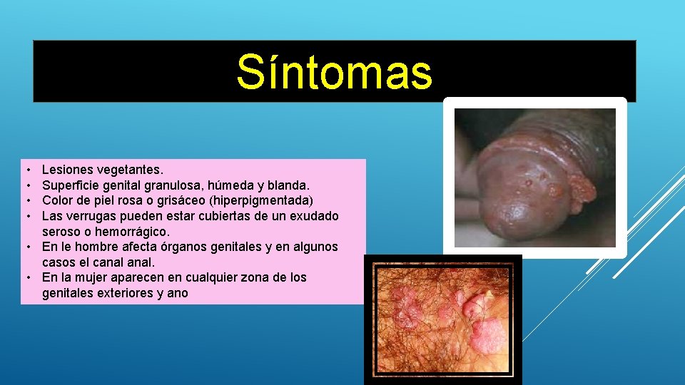 Síntomas • • Lesiones vegetantes. Superficie genital granulosa, húmeda y blanda. Color de piel