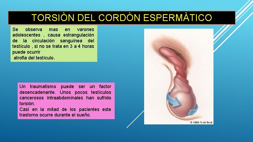 TORSIÒN DEL CORDÒN ESPERMÀTICO Se observa mas en varones adolescentes , causa estrangulación de
