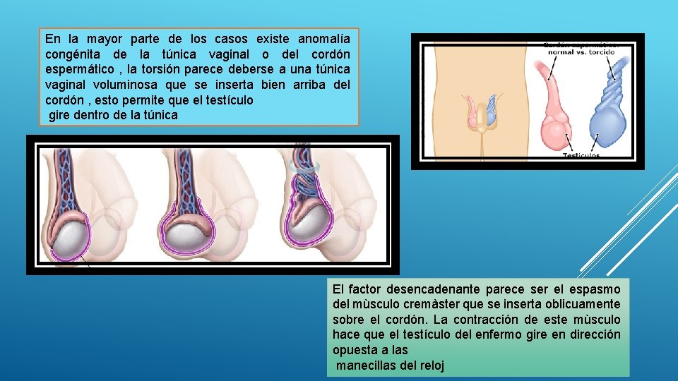 En la mayor parte de los casos existe anomalía congénita de la túnica vaginal