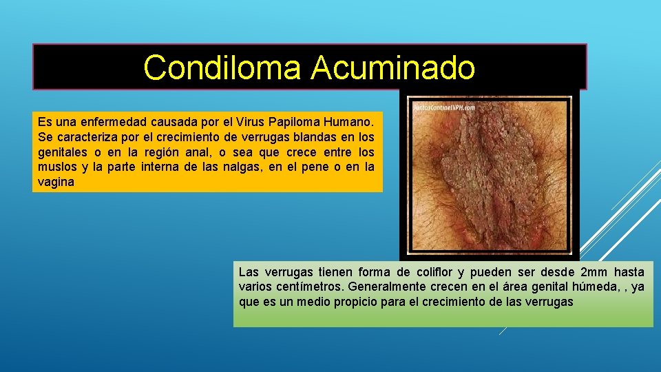 Condiloma Acuminado Es una enfermedad causada por el Virus Papiloma Humano. Se caracteriza por
