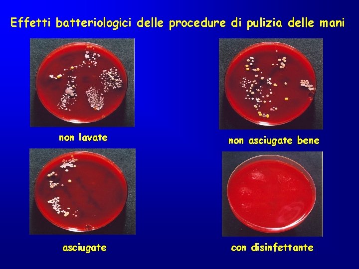 Effetti batteriologici delle procedure di pulizia delle mani non lavate non asciugate bene asciugate