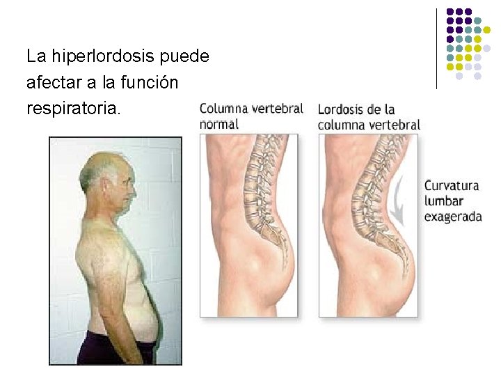 La hiperlordosis puede afectar a la función respiratoria. 